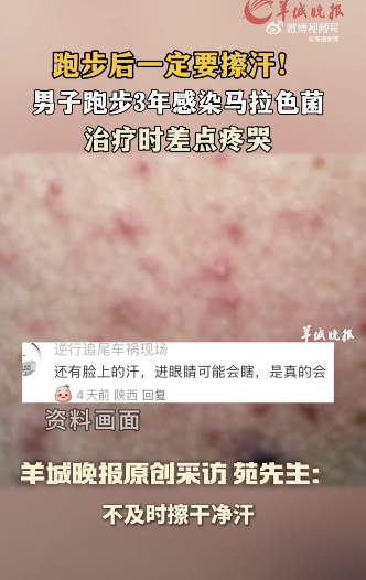 男子跑步后未擦汗感染马拉色菌